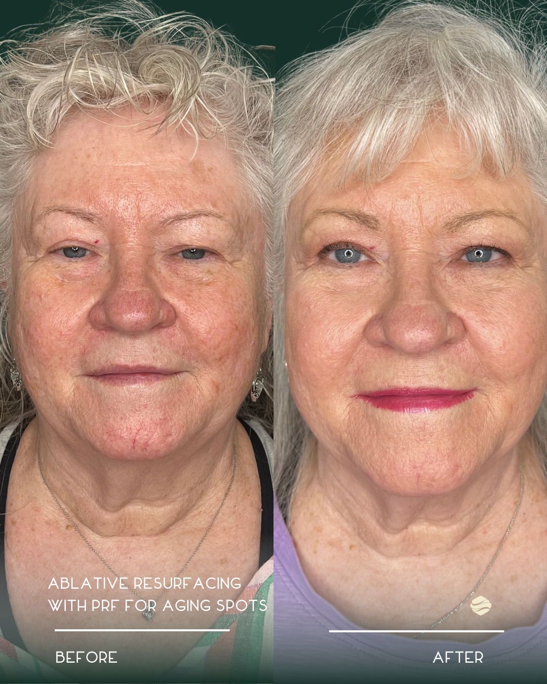 Side-by-side comparison of a woman before and after skincare treatment, showing reduced signs of aging and improved skin texture.