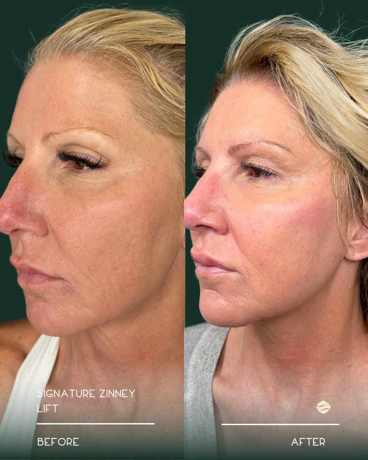 Before and after results of Signature Zinney Lift at Zinovations in Milton, GA