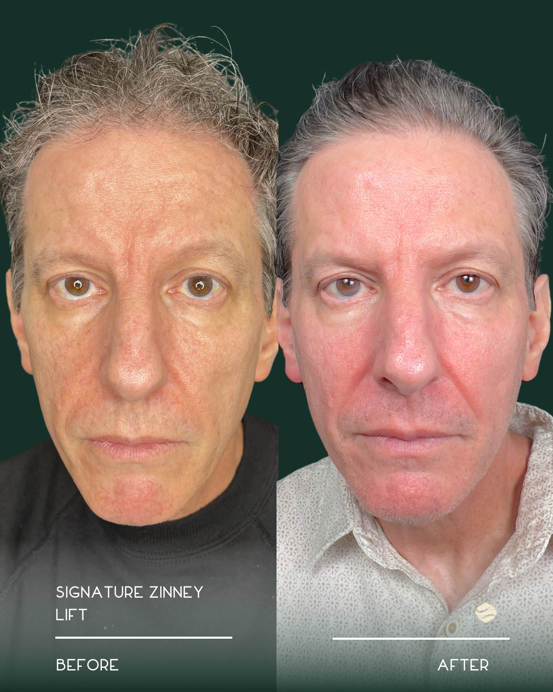 Side-by-side comparison of a man's face before and after a cosmetic procedure, showing improved skin texture and appearance. The caption mentions 'Signature Zinney Lift'.