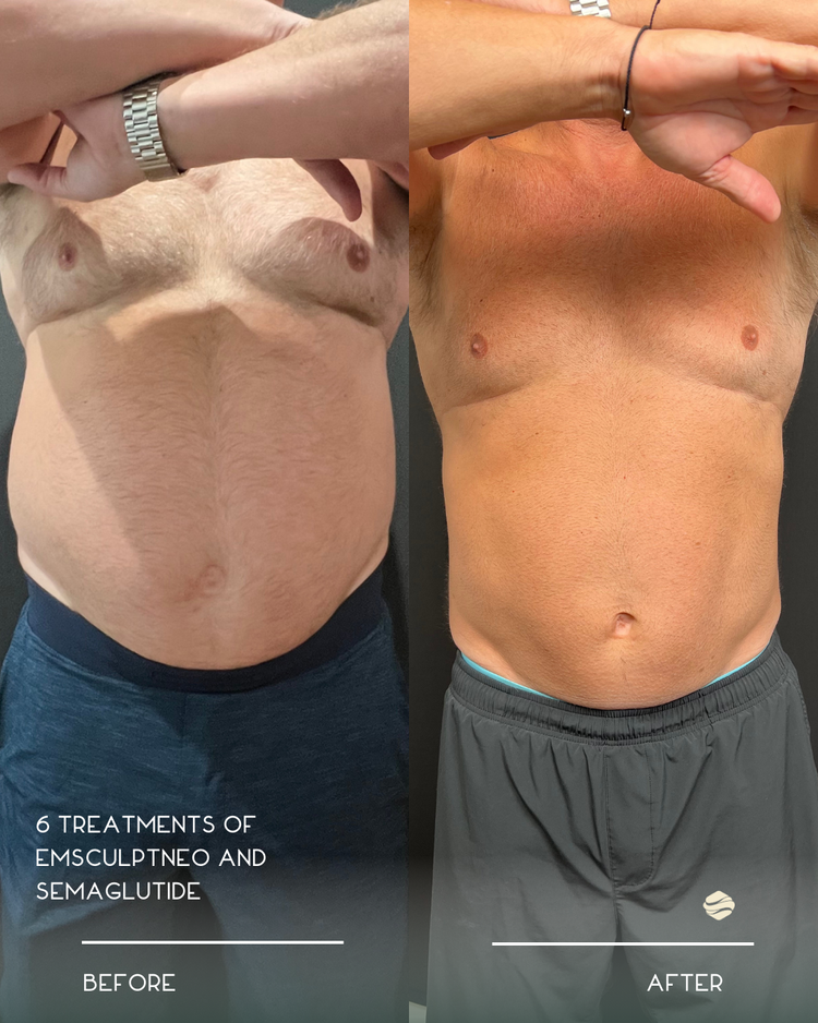 Before and after results of Emsculpt + Semaglutide (8 Treatments) at Zinovations in Milton, GA