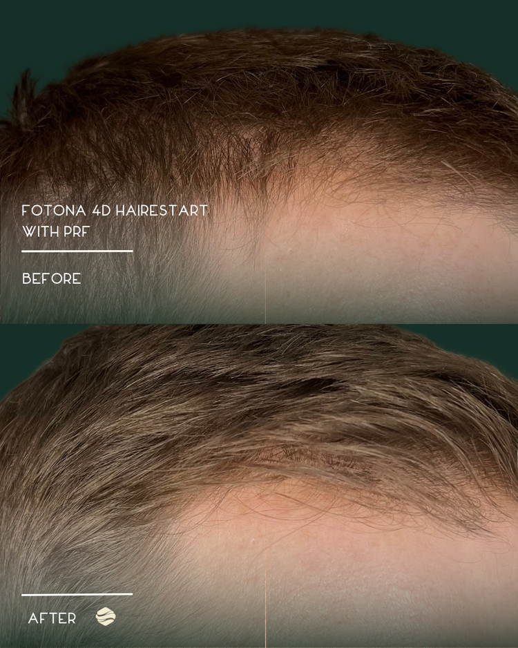 Before and after results of Fotona 4D HairStart with PRF at Zinovations in Milton, GA