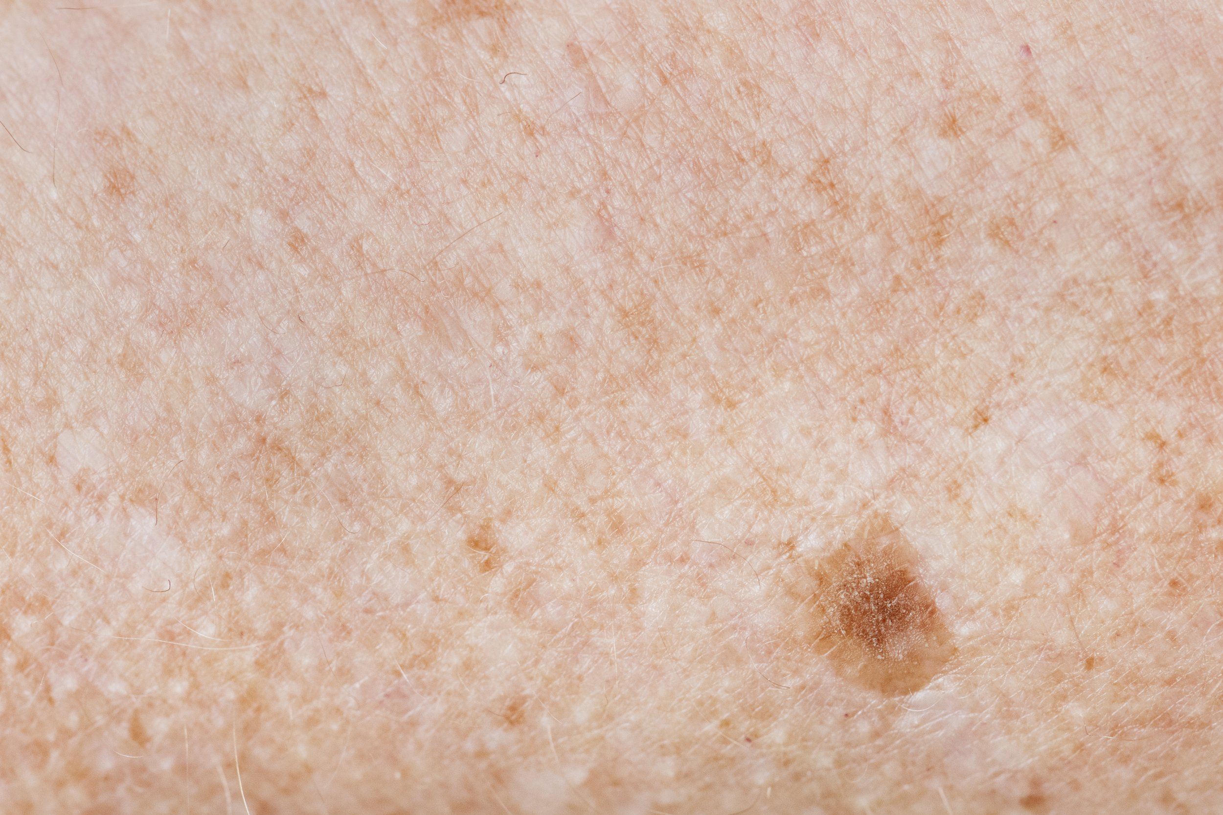 Pigmented Lesion Treatment