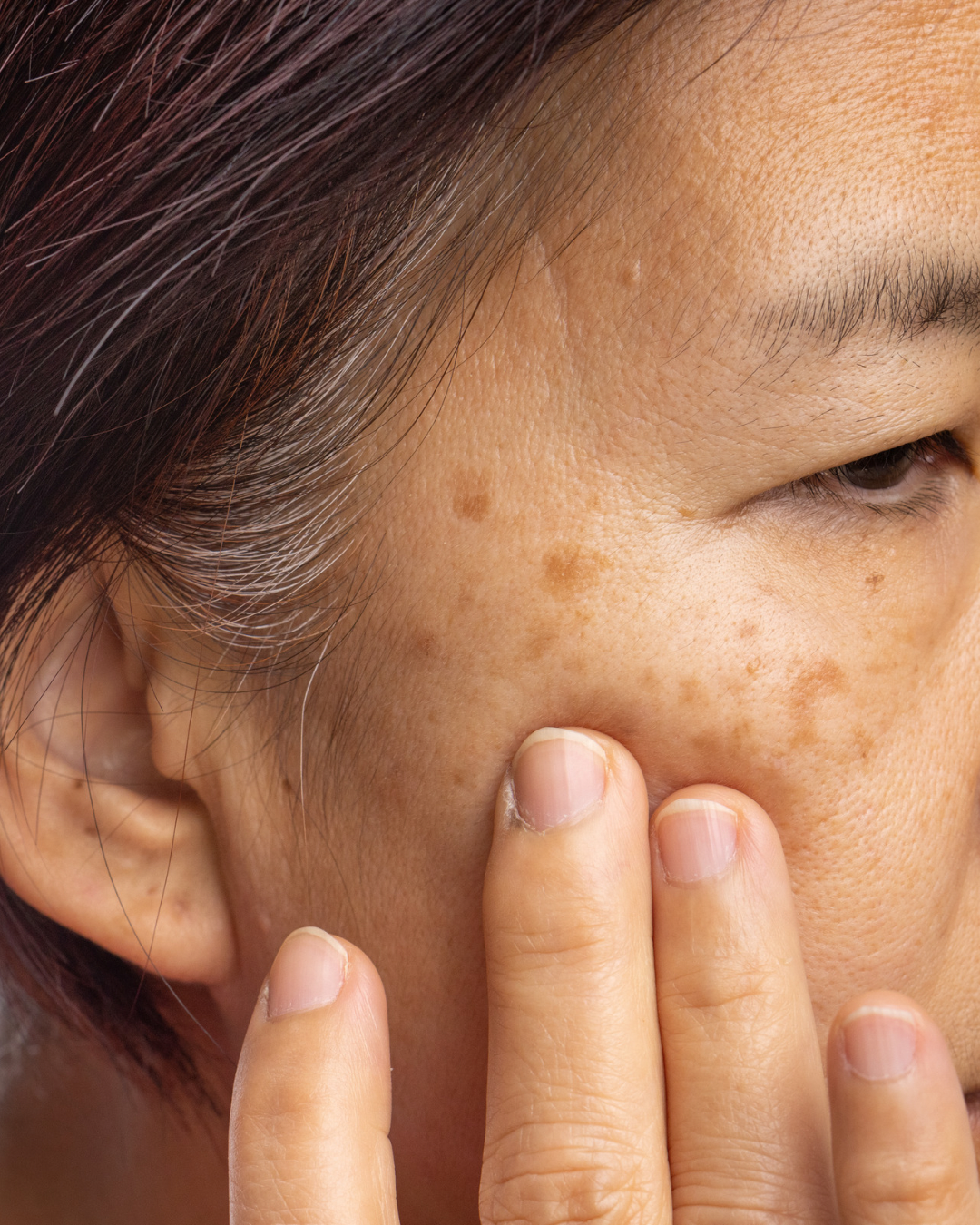 Sun Damage &amp; Age Spot Correction