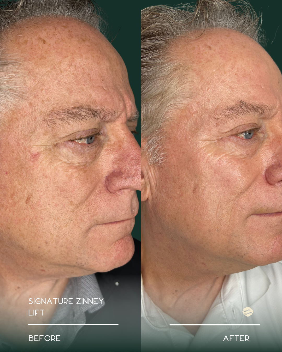 Side-by-side comparison photo of an older man, showing the left side of his face before and after a cosmetic procedure. The 'Before' image shows his skin with visible wrinkles, age spots, and some sagging. The 'After' image shows smoother skin with f