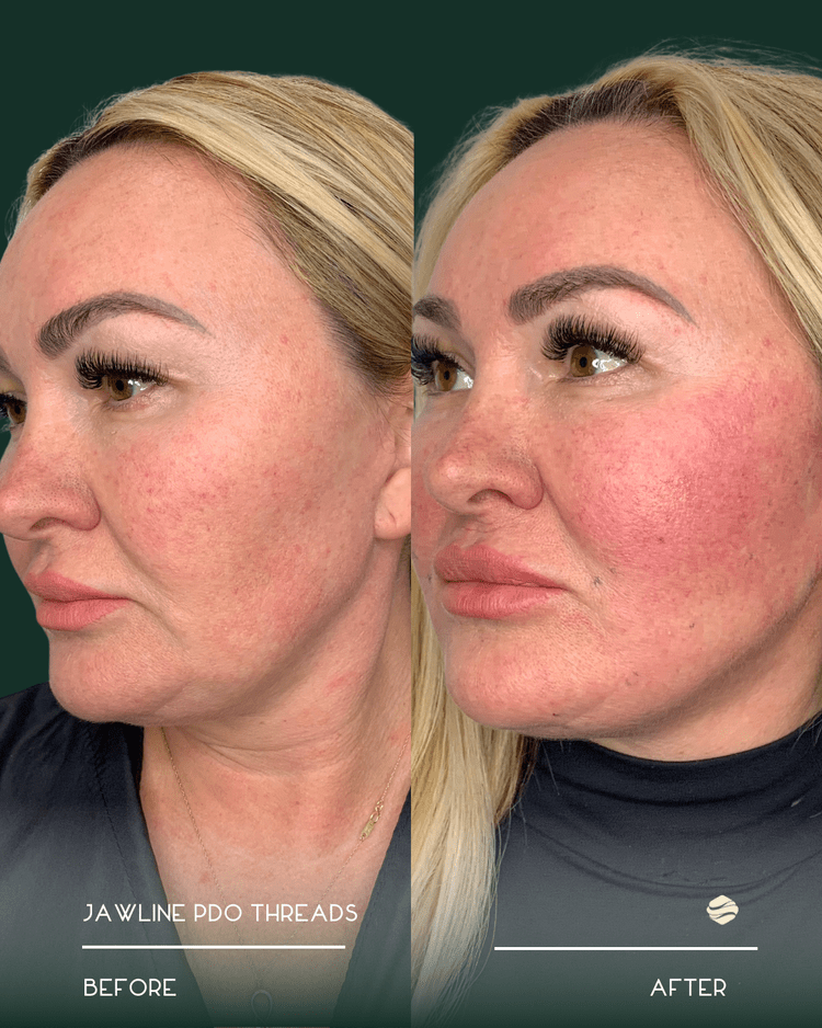 Before and after results of Jawline PDO Threads at Zinovations in Milton, GA