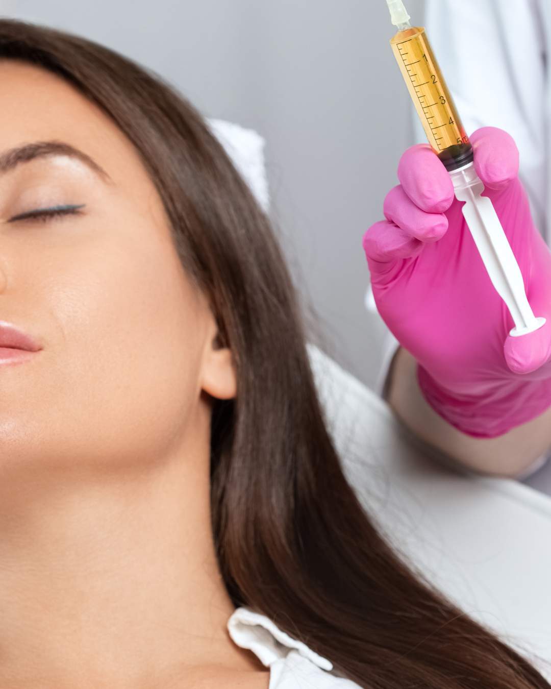 Microneedling with PRF for Hair Growth