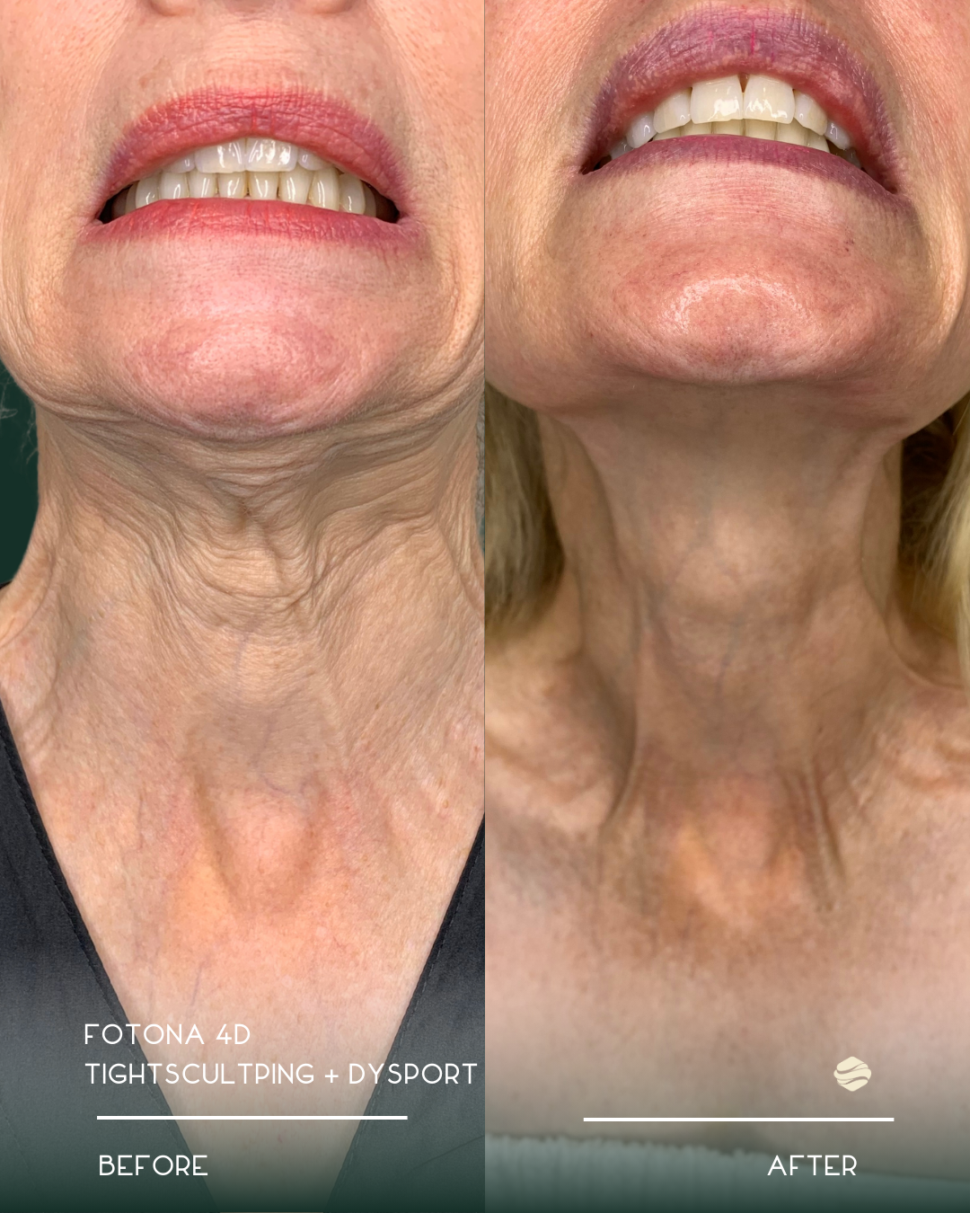 Side-by-side comparison of the lower face and neck of a woman, showing a reduction in skin wrinkles and improved skin smoothness after a treatment. The left side features the before image with more visible wrinkles and sagging, while the right side s