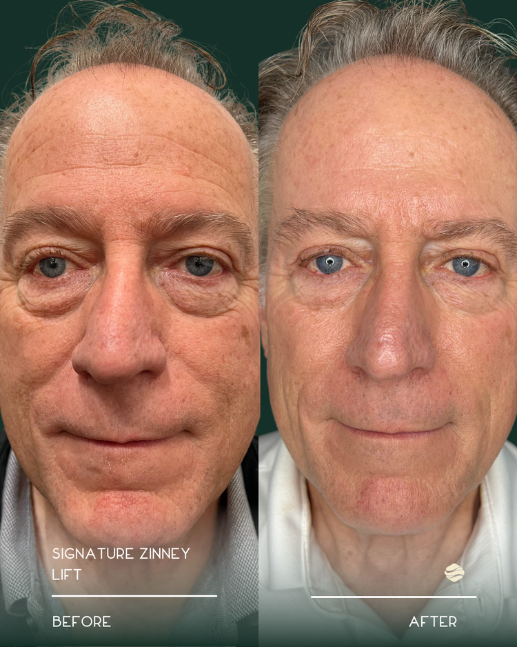 Before and after results of Signature Zinney Lift at Zinovations in Milton, GA