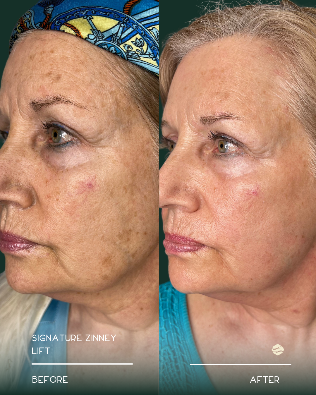 Side-by-side comparison of a woman's face before and after skin treatment. The 'before' side shows age spots and uneven skin tone, while the 'after' side shows clearer, smoother skin with reduced spots.