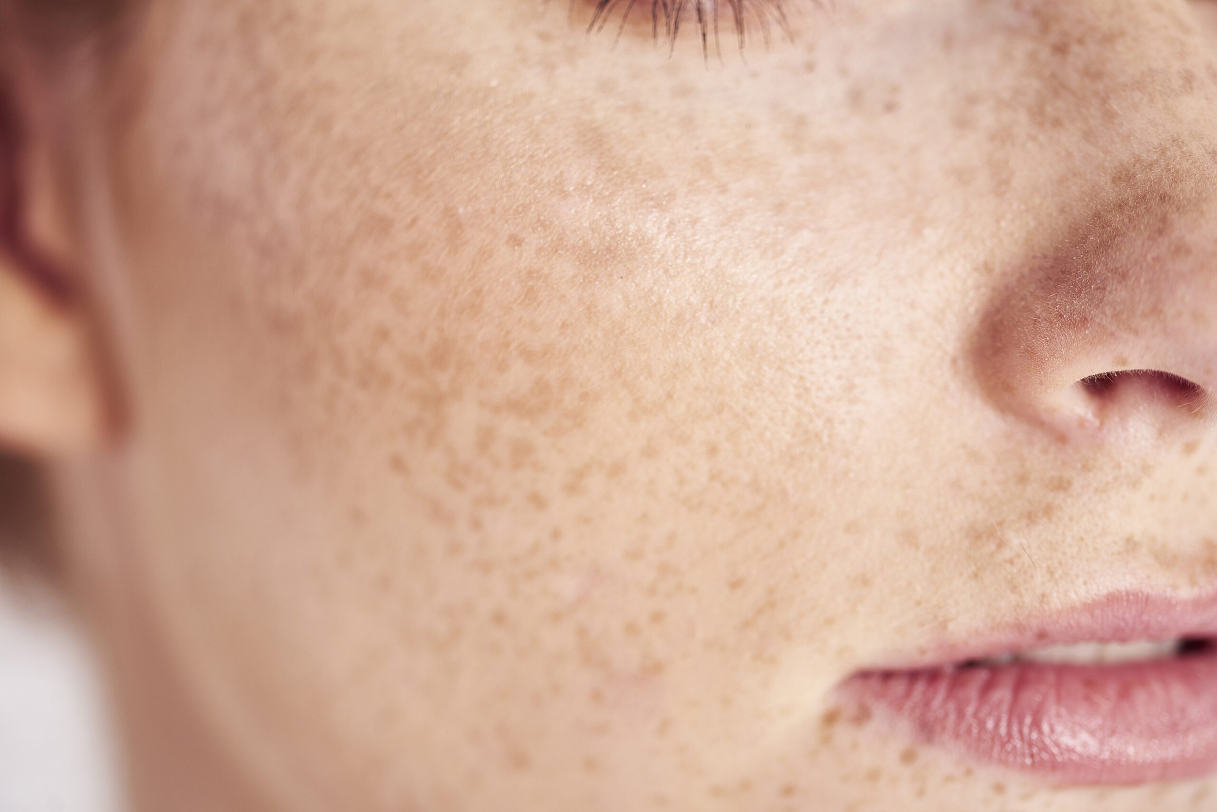 Laser Melasma Treatment