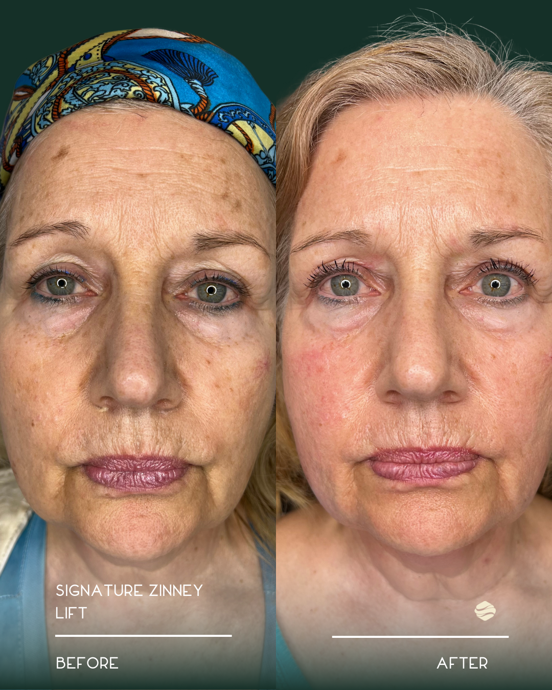 Side-by-side comparison of a woman's face before and after a cosmetic procedure. The left side shows the woman's face before the procedure, with visible signs of aging, uneven skin tone, and wrinkles. The right side shows the woman's face after the p