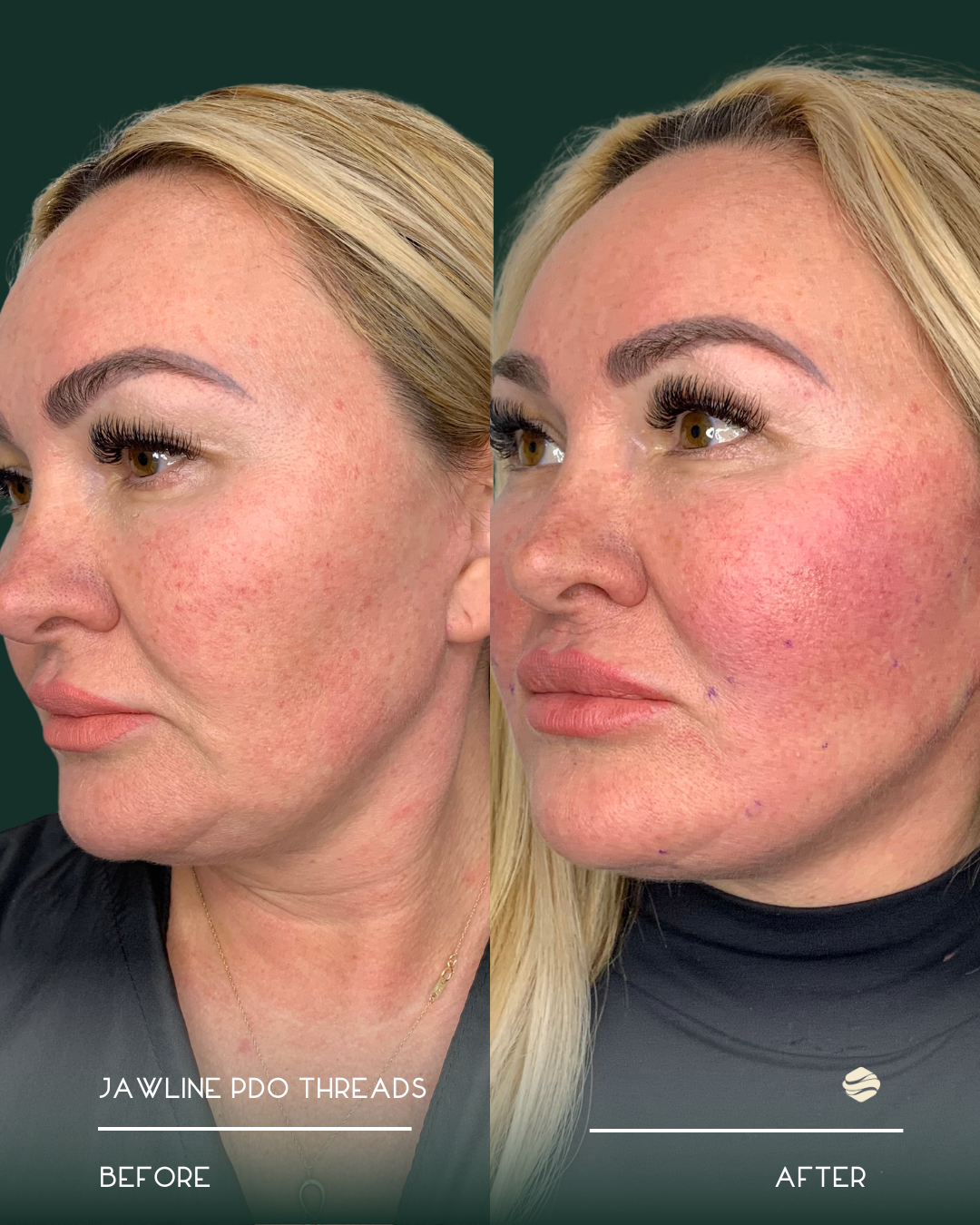 Side-by-side comparison of a woman's face before and after cosmetic procedure, showing improved skin texture, redness reduction, and enhanced eyebrow makeup.
