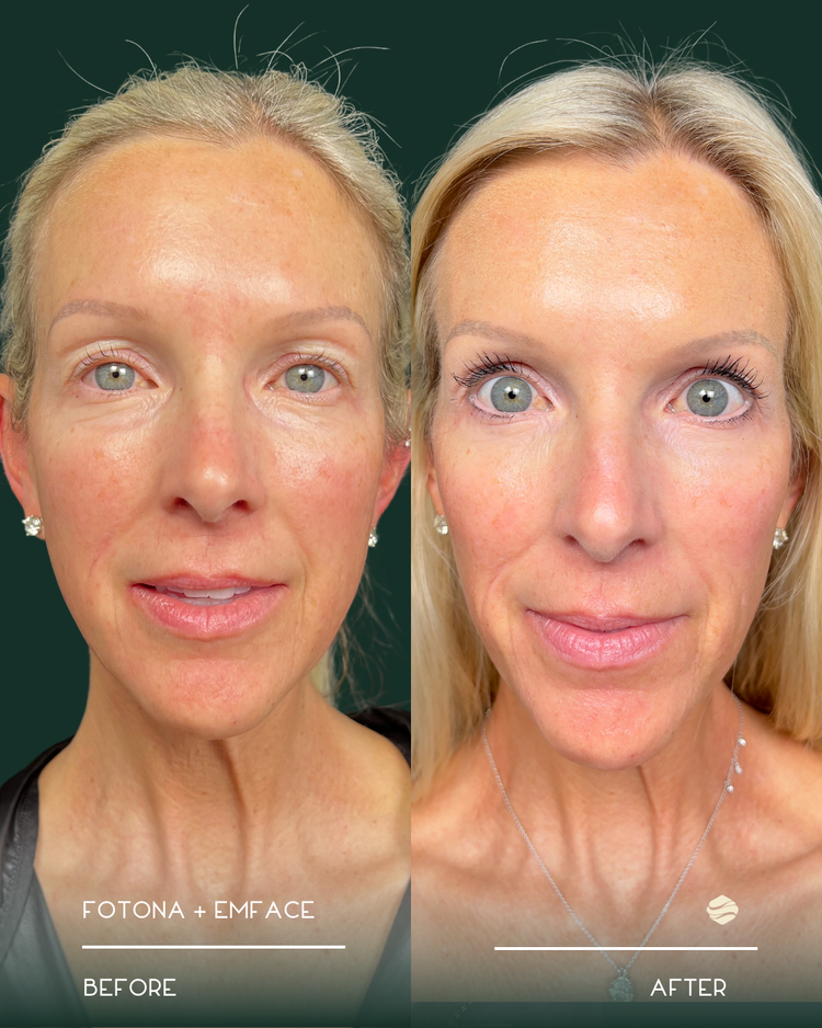 Emface Before and After Result 1