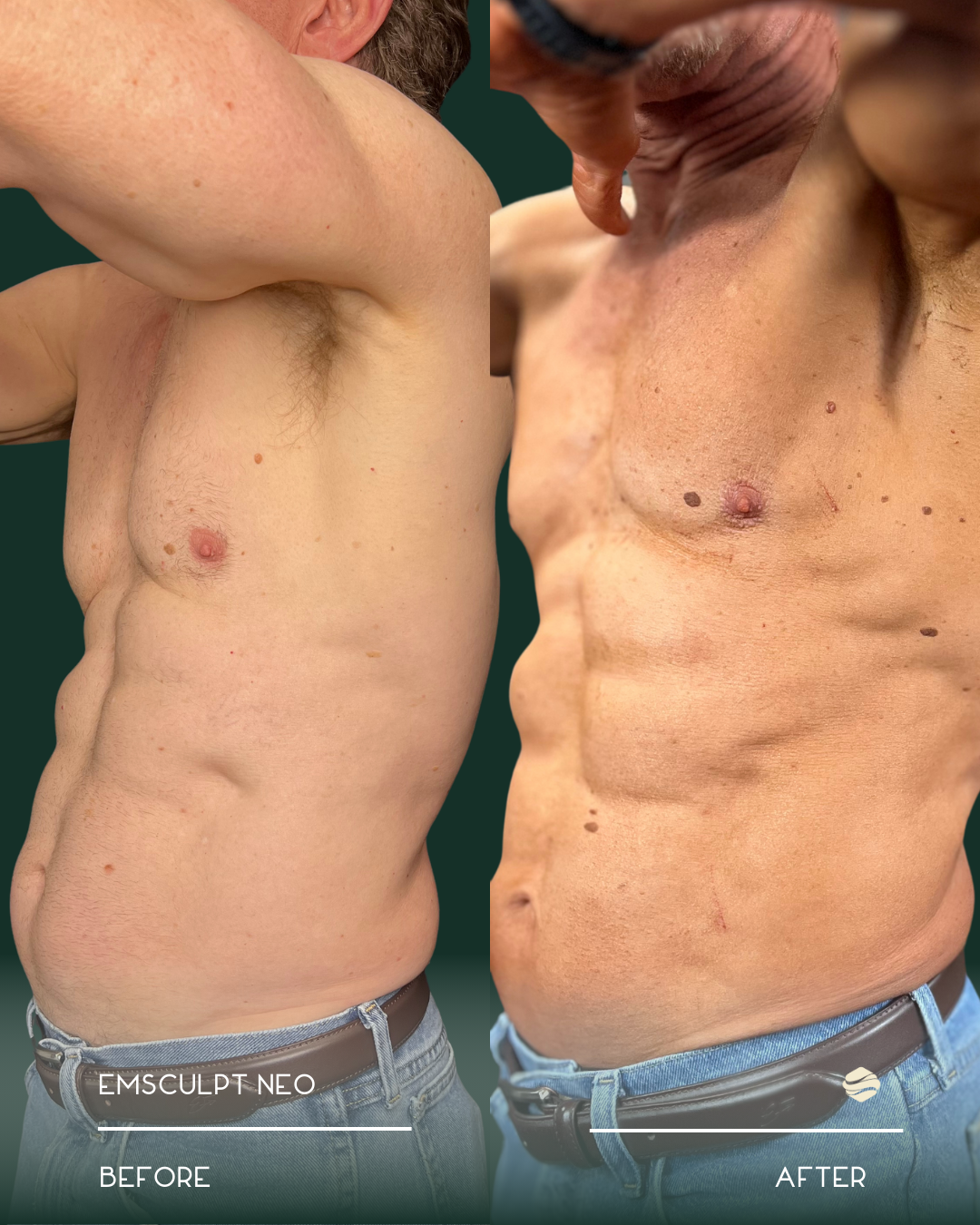 Side-by-side comparison of a male torso before and after muscle sculpting, showing increased muscle definition and contouring.