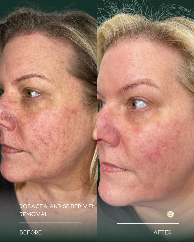Before and after results of Rosacea and Spider Vein Removal at Zinovations in Milton, GA
