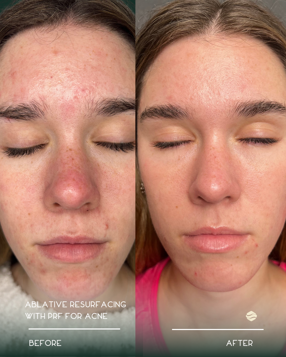 Side-by-side comparison of a woman's face showing skin improvement after ablative resurfacing with PRF for acne. The before side shows red, inflamed skin with acne scars, while the after side shows clearer, smoother skin.