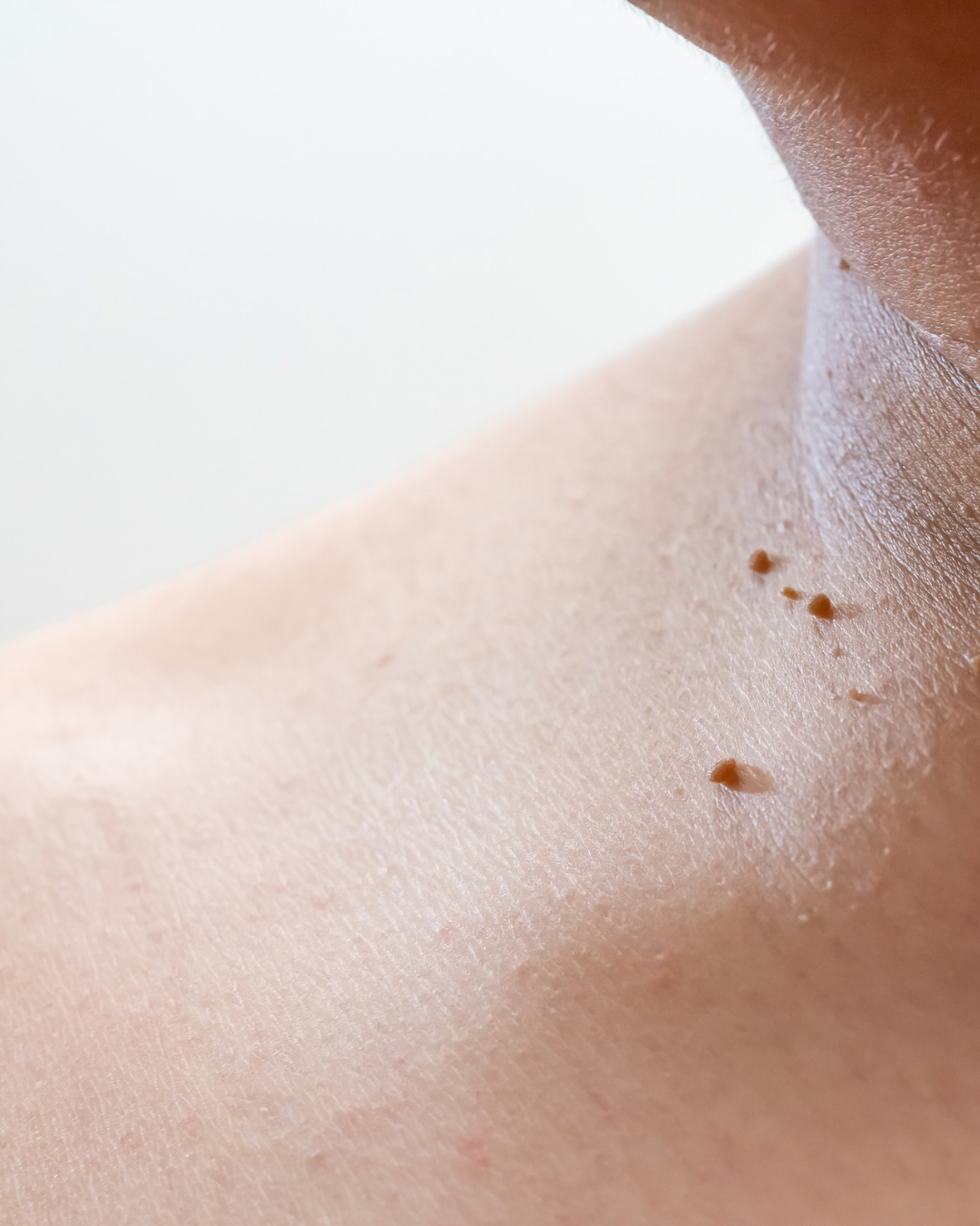 Skin Tag Removal