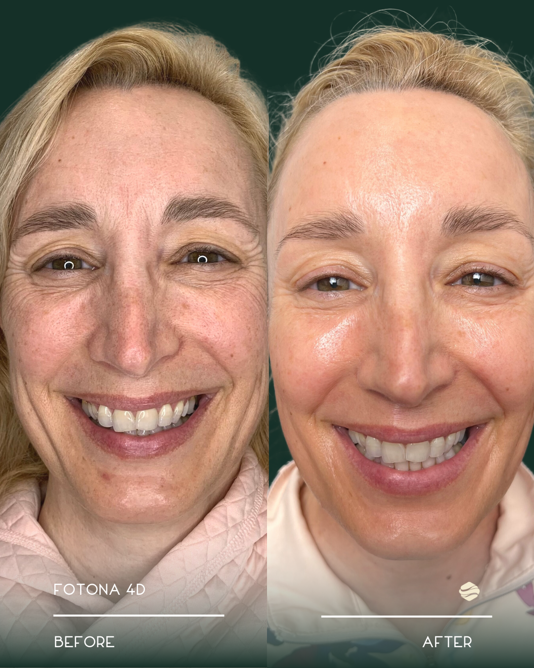 Side-by-side comparison of a woman's face before and after cosmetic treatment, showing improved skin texture and appearance.
