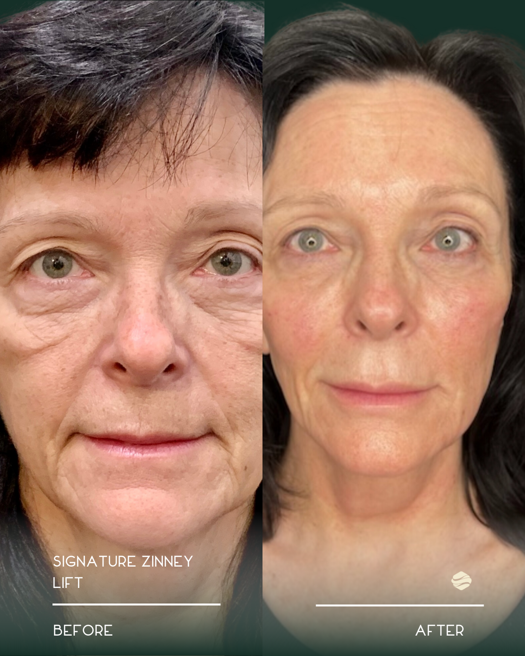 Split image showing a woman's face before and after a cosmetic treatment. The left side labeled 'BEFORE' shows her with more wrinkles and sagging skin, while the right side labeled 'AFTER' shows smoother, firmer skin with a more youthful appearance.