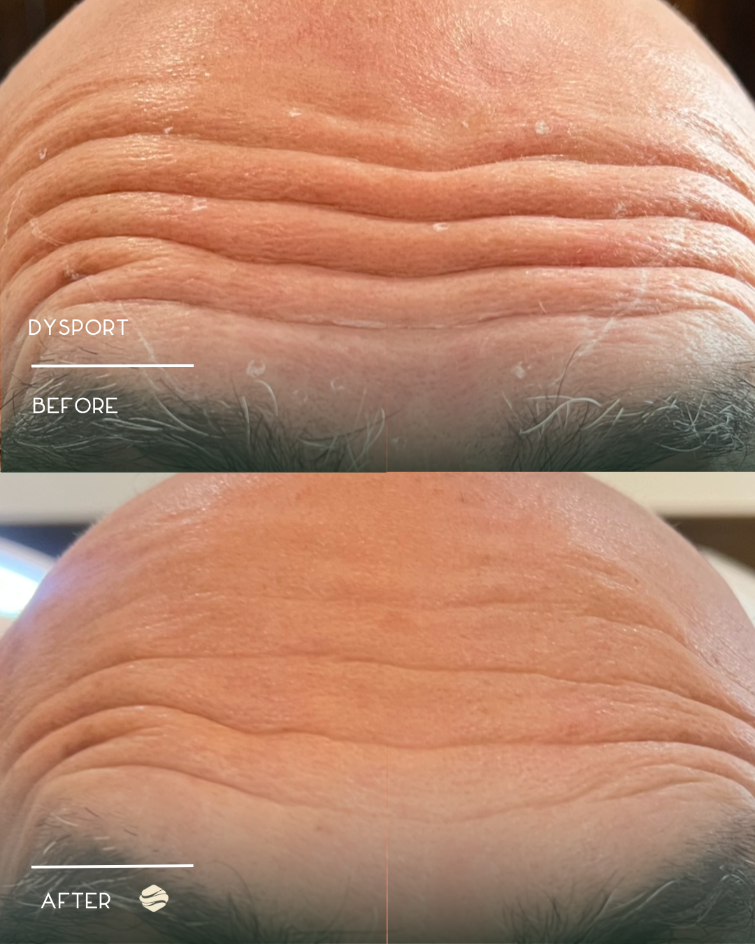 Close-up of forehead showing wrinkles before and after a treatment, with smoother skin in the after image.