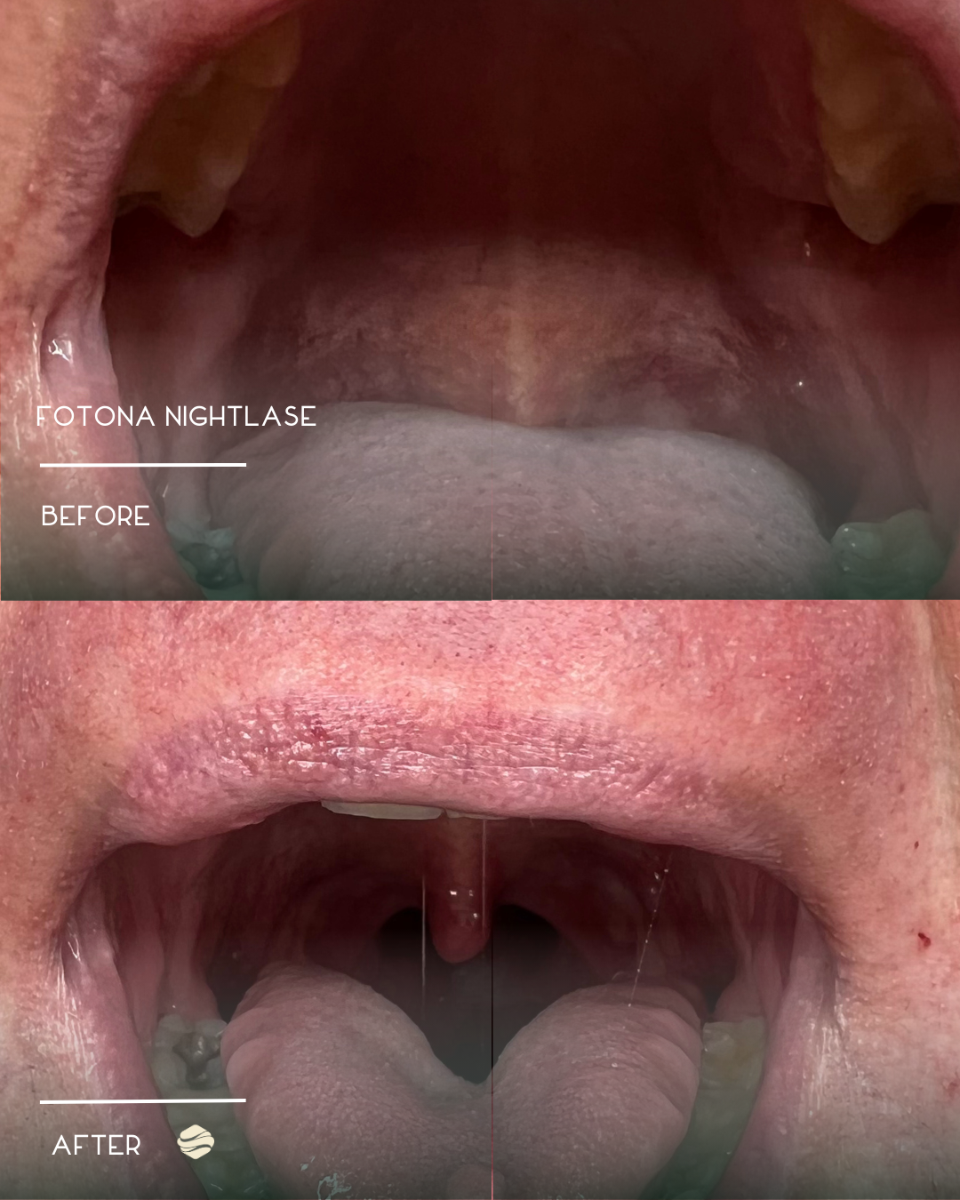 Comparison of a person's mouth before and after using Fotona Nightlase, showing reduced throat tissue in the after image.