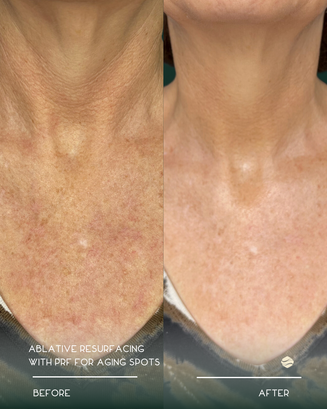Close-up of a person's neck and upper chest showing a before and after comparison of skin treatment. The before side shows aging spots and uneven skin texture, while the after side shows smoother, clearer skin.