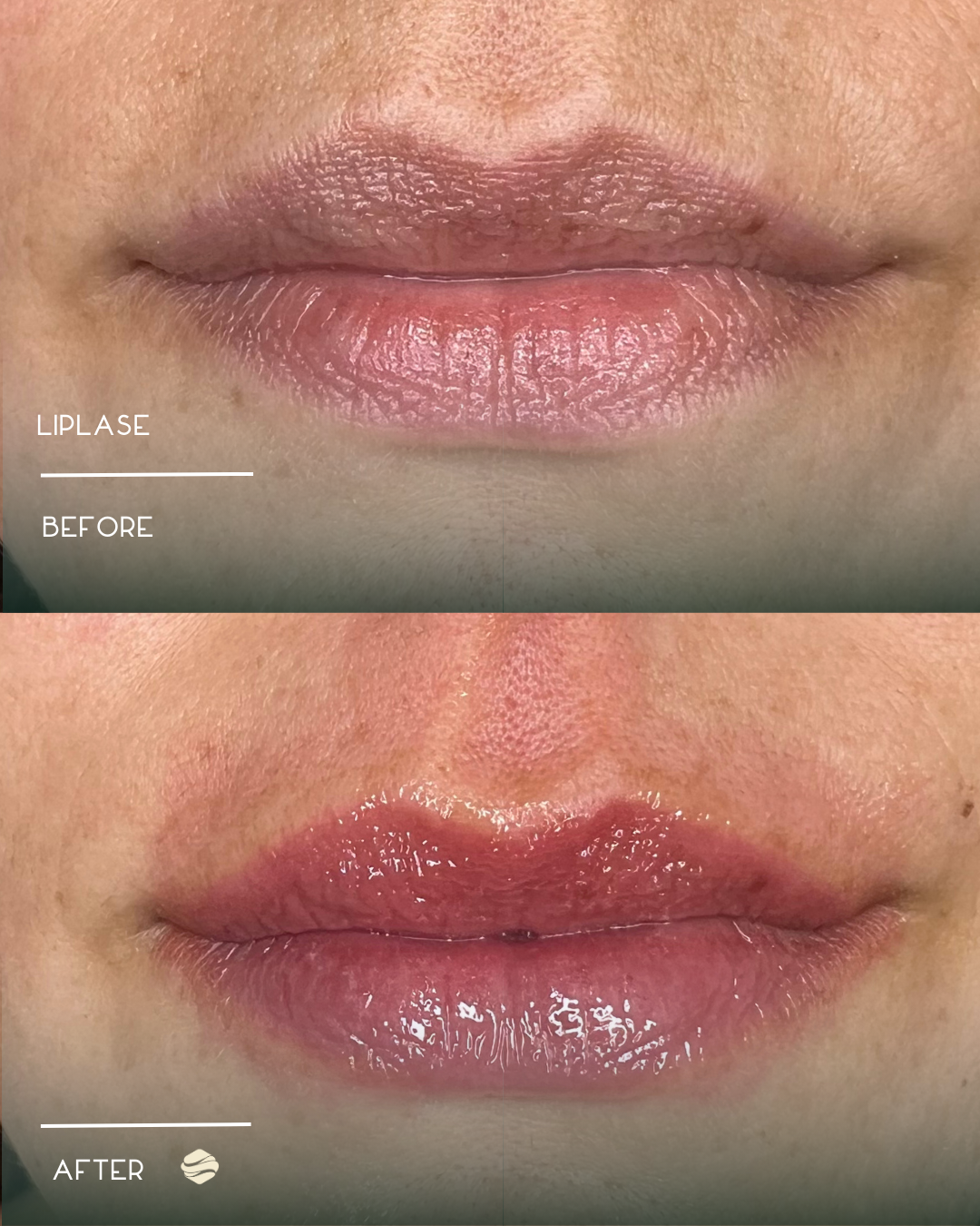 Comparison of lips before and after LipLase treatment, showing increased lip volume and glossiness post-treatment.