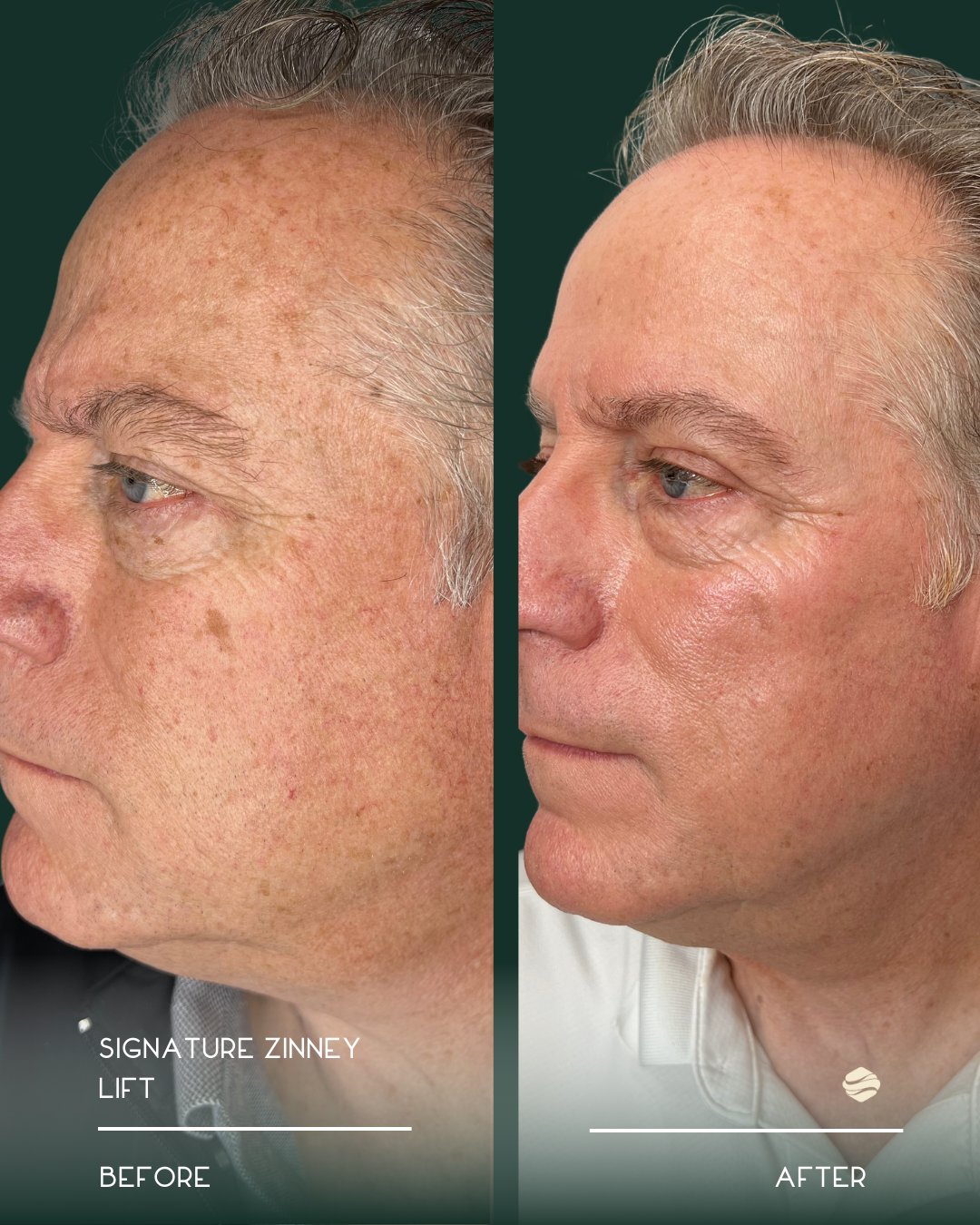 Side-by-side comparison of a man's face showing the results of a skincare treatment, with the left side labeled 'Before' revealing sun damage and uneven skin tone, and the right side labeled 'After' showing smoother skin with reduced pigmentation and