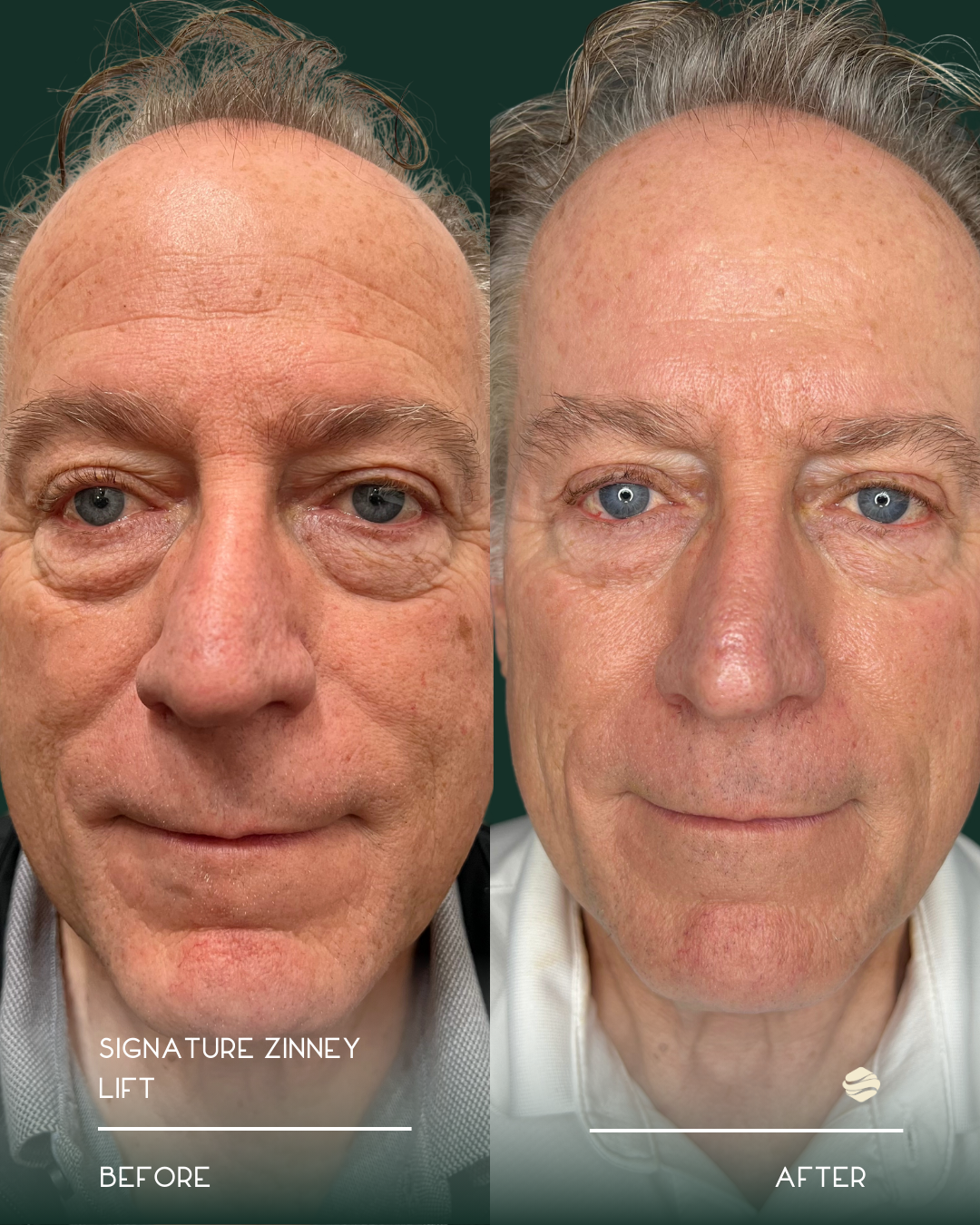 Side-by-side comparison of a middle-aged man before and after a skin lift procedure, showing reduced puffiness and smoother skin around the eyes.