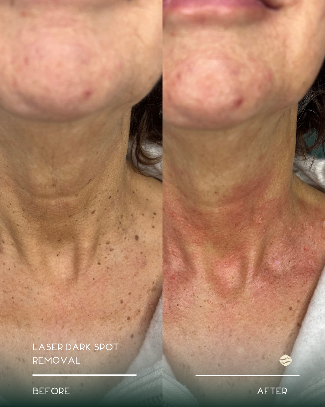 Comparison of a person's neck and lower face before and after laser dark spot removal treatment, showing reduction in dark spots and improved skin tone.