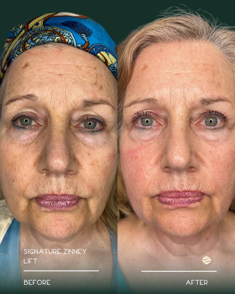 Before and after results of Signature Zinney Lift at Zinovations in Milton, GA