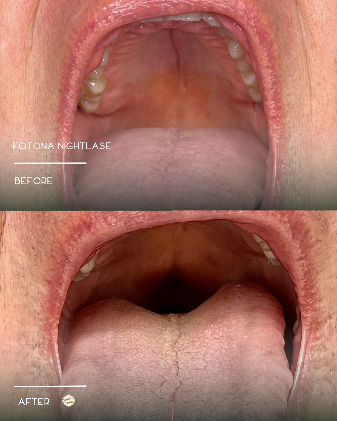 Comparison of a person's open mouth before and after using Fotona Nightlase. The "before" image shows a red, inflamed throat, while the "after" image shows a less inflamed throat with improved tissue appearance.