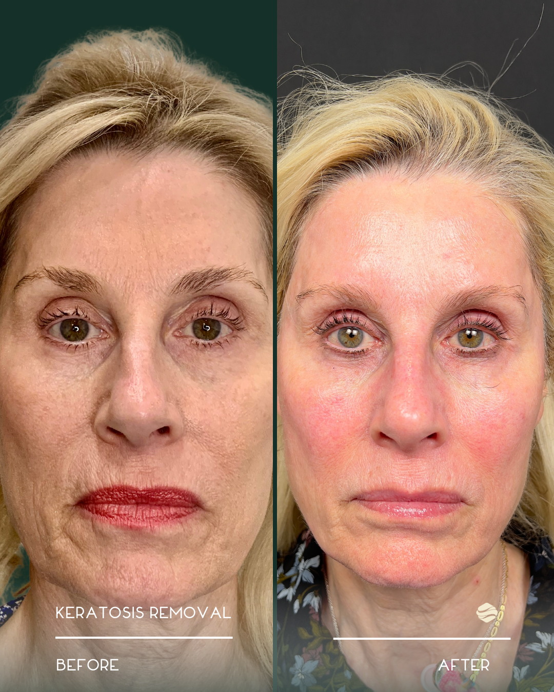 Side-by-side comparison of a woman's face before and after keratosis removal, showing smoother skin and reduced roughness after treatment.