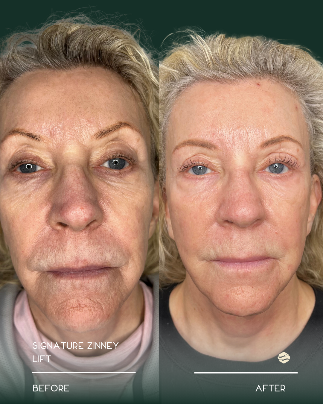 Side-by-side comparison of a woman's face before and after a skincare treatment, showing reduced wrinkles and even skin tone.