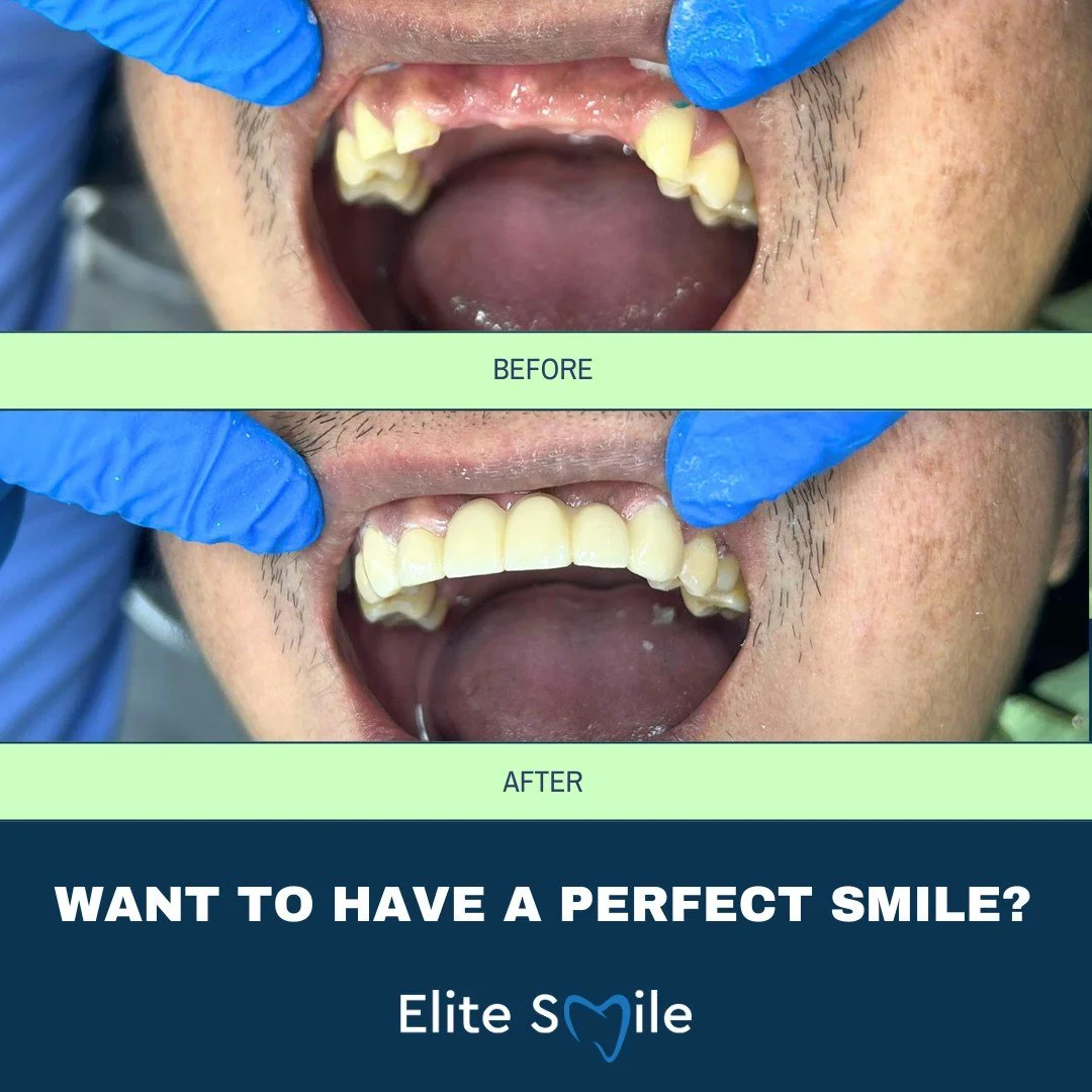 A smile can truly change everything. ✨

Check out this stunning before &amp; after transformation by our expert dental team at Elite Smile Livingston.

Whether it&rsquo;s cosmetic dentistry, restorative treatment, or simply boosting confidence &ndash