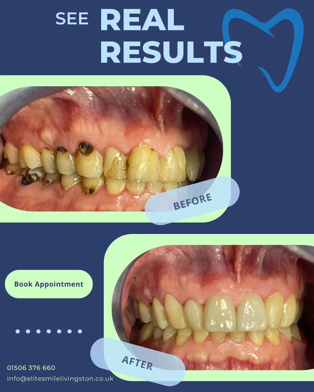 From worn and damaged teeth to a confident, healthy smile ✨
This incredible transformation was achieved through a full mouth rehabilitation, restoring both function and aesthetics, because every detail matters.
Your dream smile starts with a single