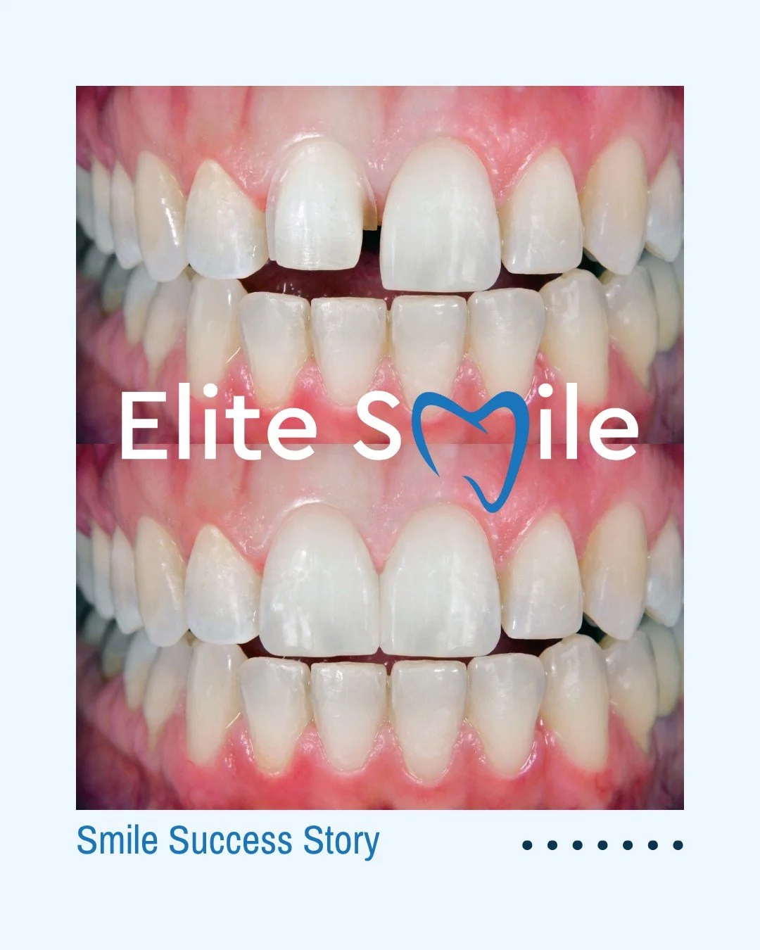Another smile success story!
Sometimes it’s the small changes that make the biggest difference and the biggest confidence boost 😁
Your dream smile could be just one appointment away.
 Book your consultation today!
📞 01506 376 660
 🌐 elitesmi
