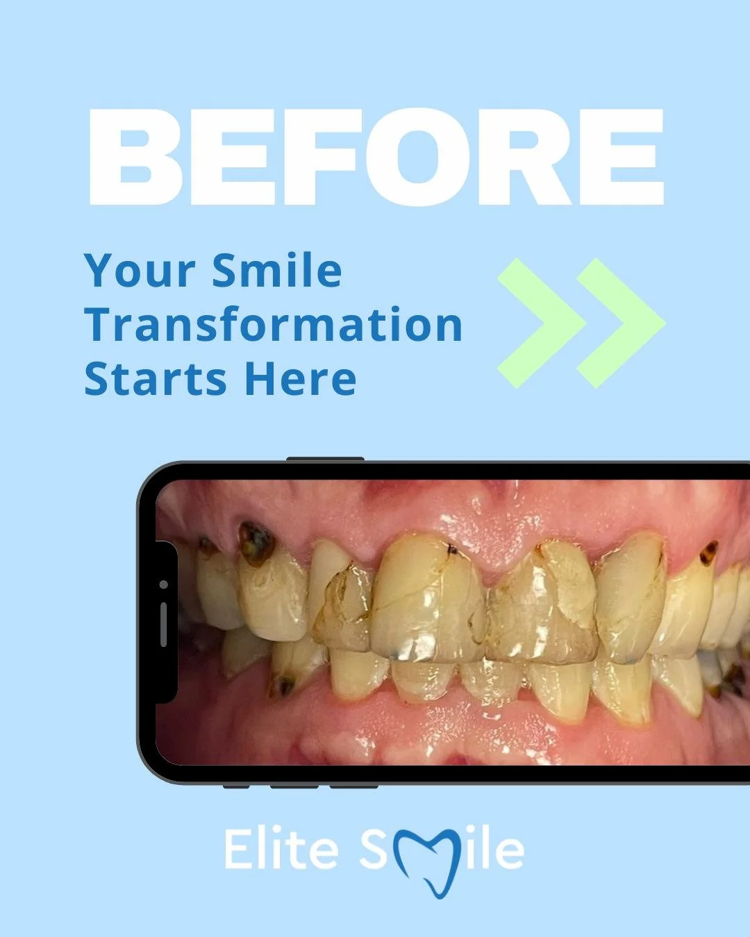 Another beautiful smile transformation ✨
Small changes can make a big difference and this patient&rsquo;s results speak for themselves.
Personalised care, natural-looking improvements, and confidence restored 💙
Ready for your own smile makeover?
📞 