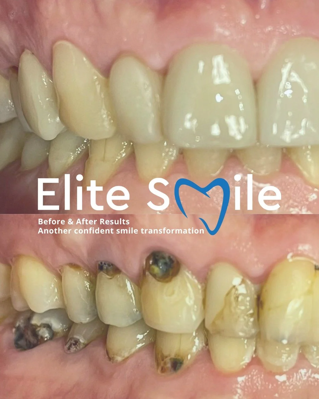 One slide, big impact ✨
Another beautiful smile transformation completed at Elite Smile, proving that even small changes can make a huge difference in confidence.
Thinking about your own smile journey? We&rsquo;re here to help.
 📞 01506 376 660
 🌐 