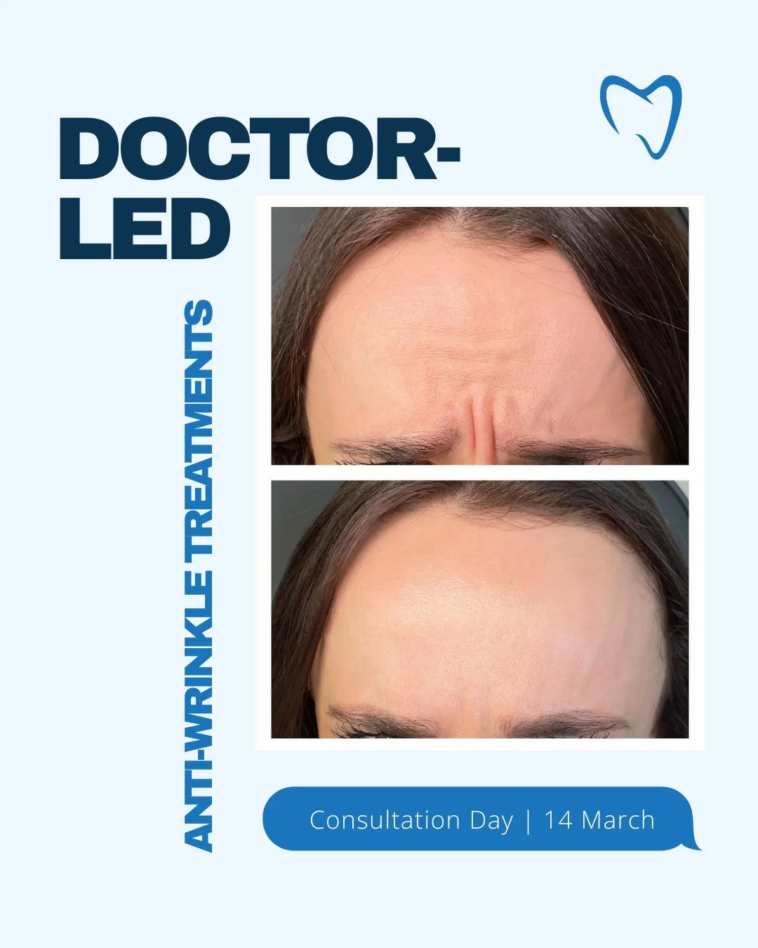 Our Anti-Wrinkle Consultation Day offers personalised treatment planning with experienced clinicians.

Proposed treatment pricing:
&bull; 1 area &ndash; &pound;150
&bull; 2 areas &ndash; &pound;225
&bull; 3 areas &ndash; &pound;280
&bull; Masseter &n
