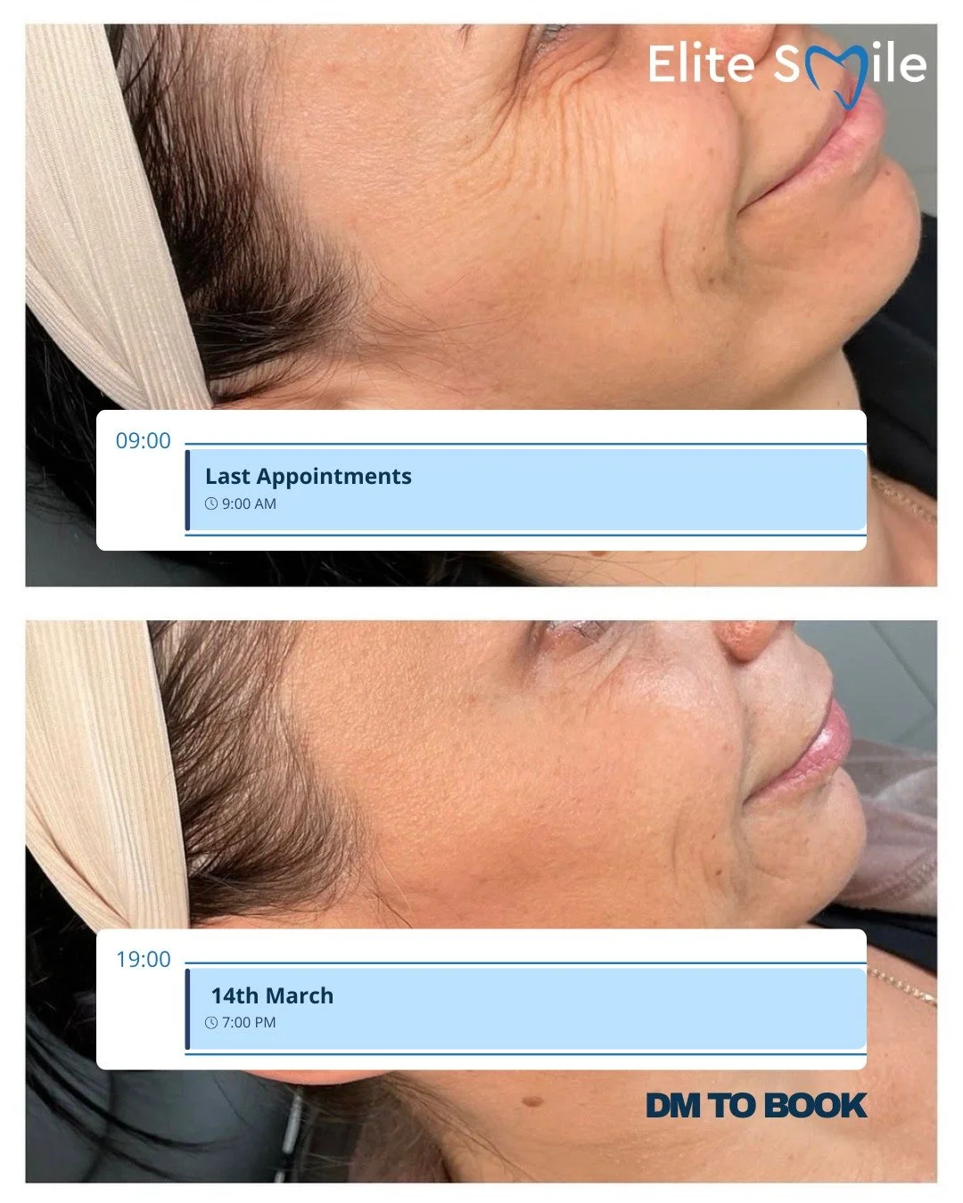 Our Anti-Wrinkle Consultation Day is almost fully booked.

📅 14th March
⏰ 9am&ndash;7pm

&pound;29 consultation
Deducted if you proceed on the day.

If you&rsquo;ve been considering subtle, professionally delivered aesthetic treatment, this is your 