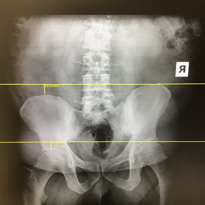 Chiropractor hip x-ray before The Wellness Way Largo