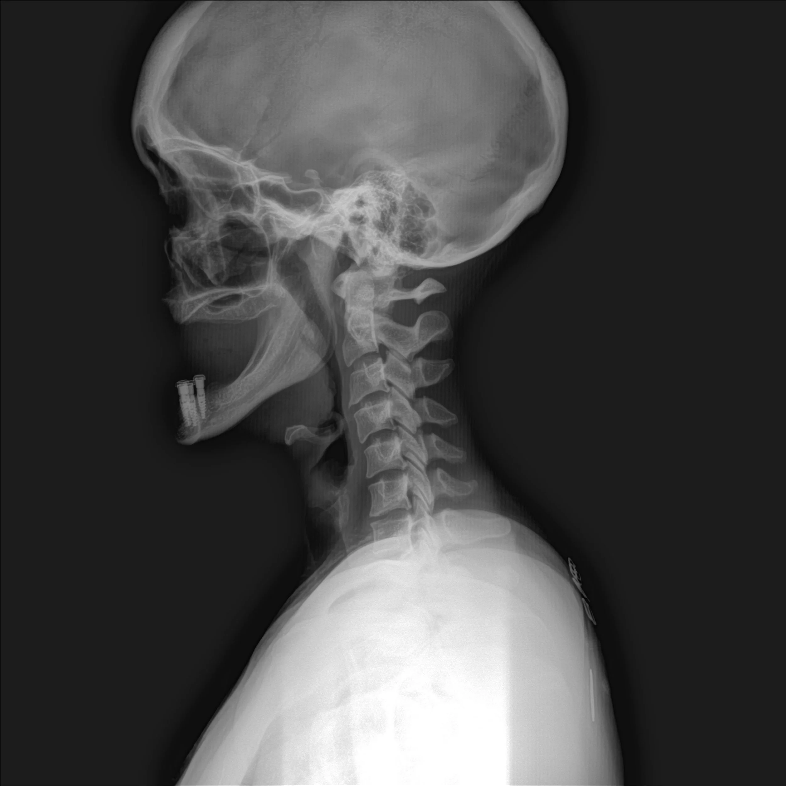 Spinal misalignment in the cervical (neck) region before chiropractic adjustments, causing tension, headaches, and restricted movement.