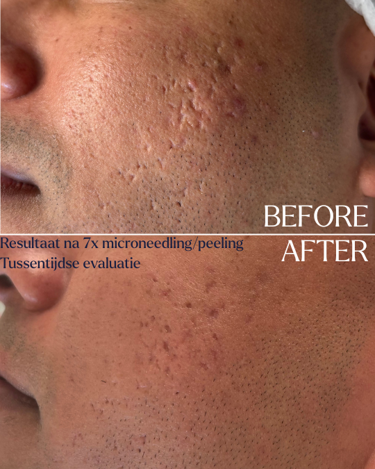 7x microneedling i.c.m. peeling. Dit is een tussenevaluatie, nog geen eindresultaat.