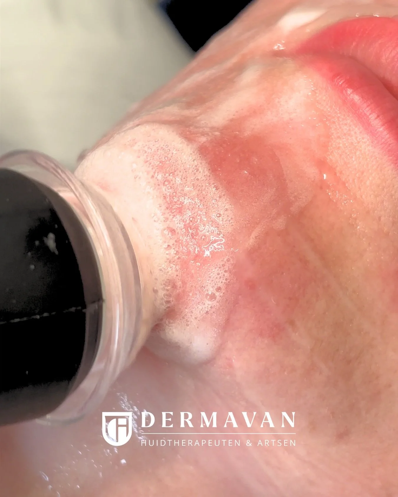 🇳🇱 Review over XL Hair bij Dermavan
“Ik heb bij Dermavan een reeks behandelingen met XL Hair gedaan en ben ontzettend tevreden! Mijn haaruitval is duidelijk verminderd en mijn haar voelt voller en gezonder aan. De huidtherapeut neemt echt de