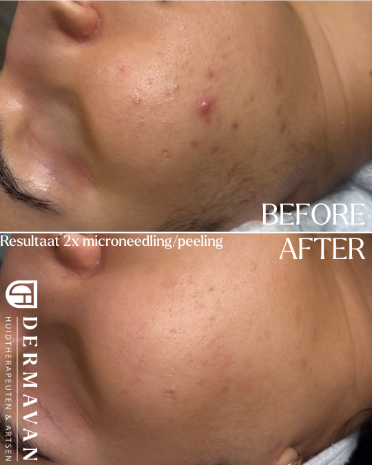 Acne, PIE en PIH verminderd na 2 behandelingen bij een getinte huid.