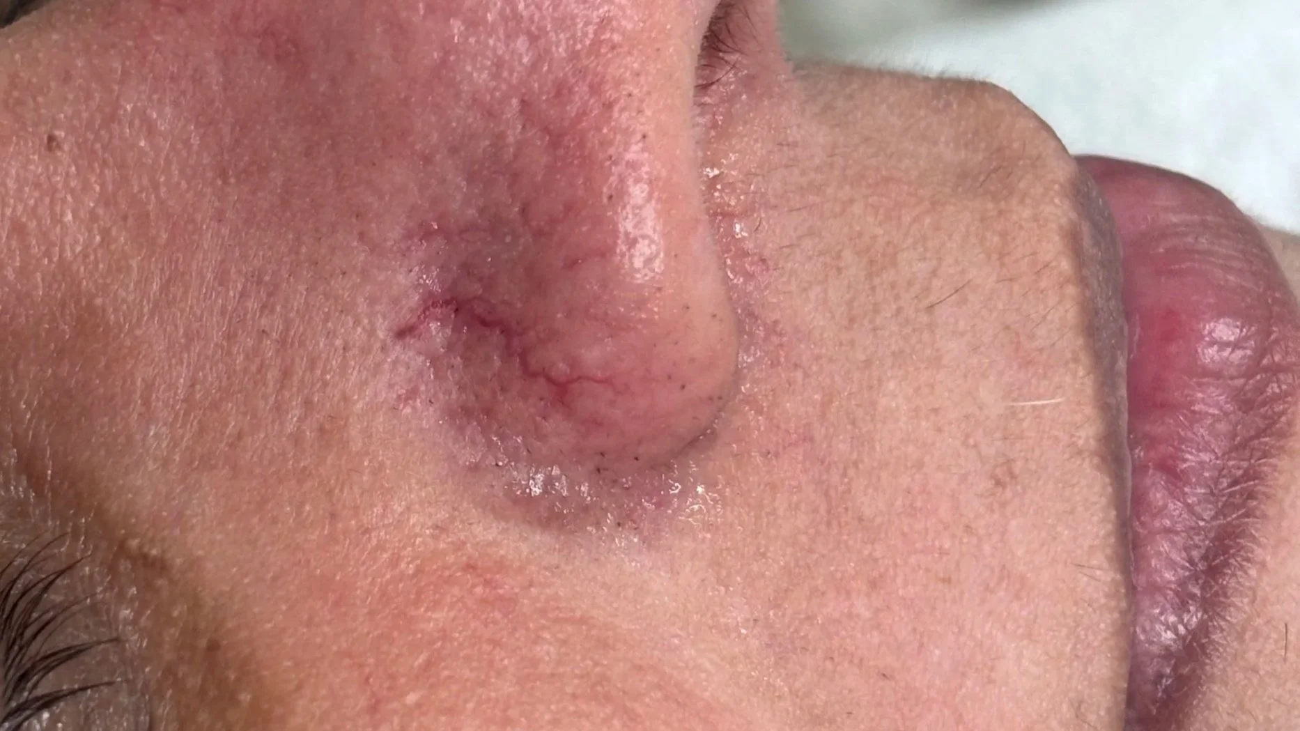 Couperose/kleine bloedvaatjes gezicht