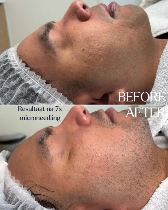 7x microneedling i.c.m. peeling. Dit is een tussenevaluatie, nog geen eindresultaat.