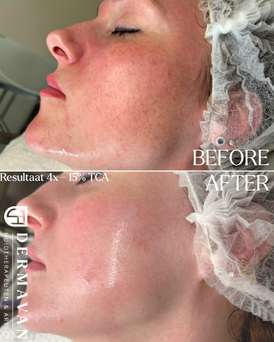 Sproetjes/pigmentatie, acne en roodheid verminderd na 4x 15% TCA peeling bij een lichte huid.