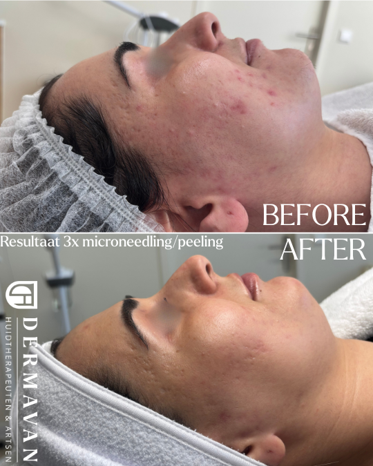 Actieve acne verdwenen na 3 behandelingen bij een licht getinte huid.